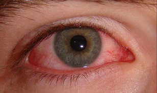 Đau mắt đỏ